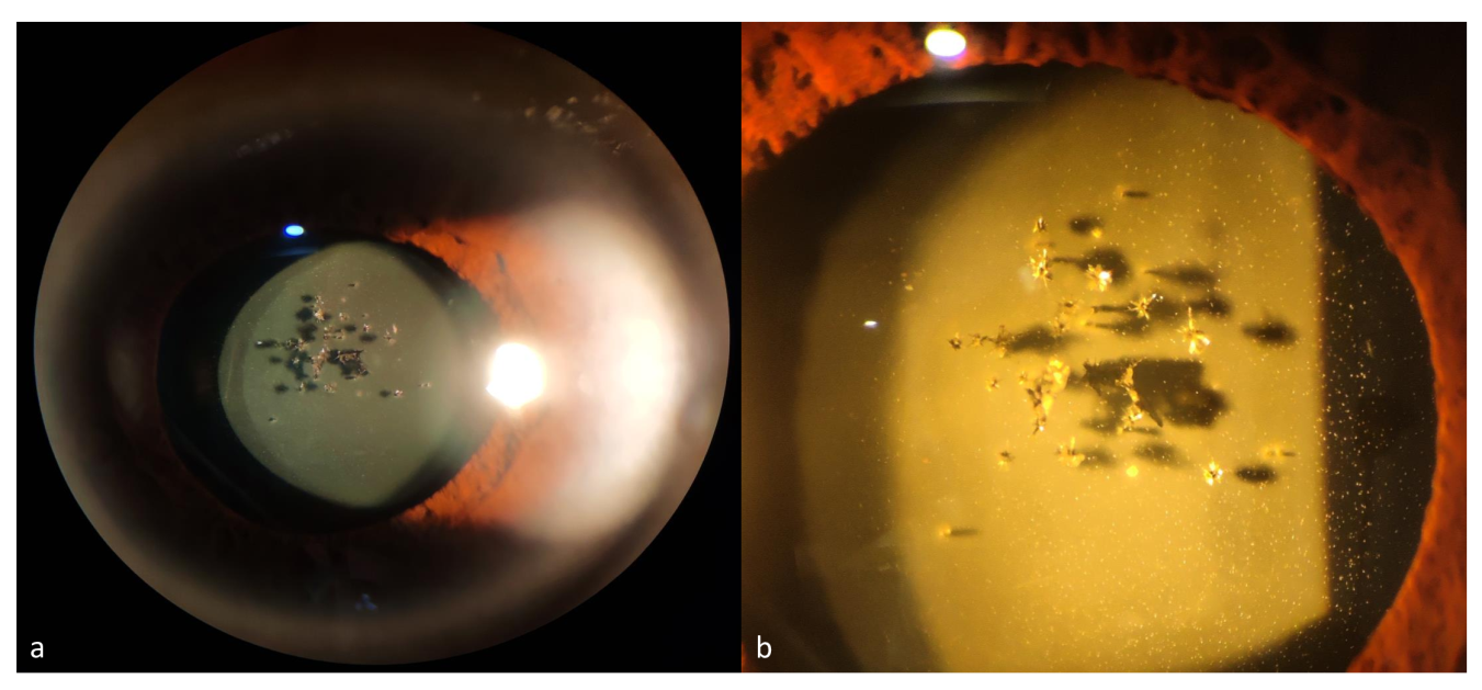 IOL Pitting in an Opacified IOL Post Nd Yag Capsulotomy